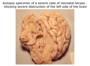 Autopsy specimen of a severe case of neonatal herpes - showing severe destruction of the left side of the brain