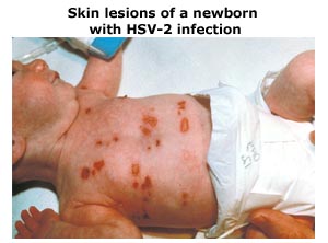 Skin lesions of a newborn with HSV-2 infection