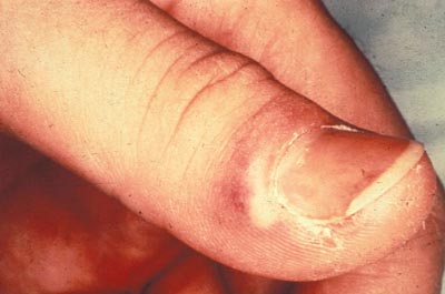 Herpes of the Thumb.- Herpetic Whitlow