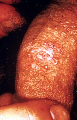 recurrent herpes -- male