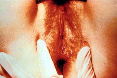 recurrent herpes -- female