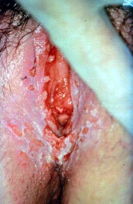 primary herpes -- female