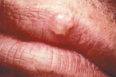 A fever blister due to HSV-1